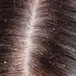 10 Ways to Deal With Dandruff