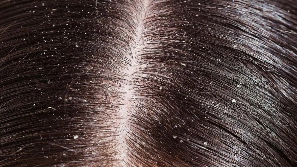 10 Ways to Deal With Dandruff