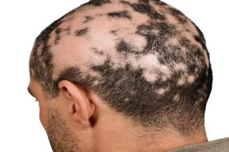 What are the Causes, Symptoms, and Treatments of Alopecia Areata