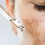 Best Skincare Products for Hyperpigmentation