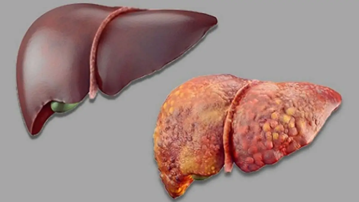 10 Warning Signs Your Liver Might Be Unhealthy: What to Watch Out For