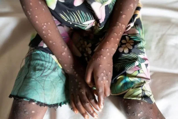 Department of Health Encourages Vigilance, Not Panic, in Response to Mpox