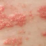Shingles: Recognising the Shingles Symptoms and Exploring Treatment Options