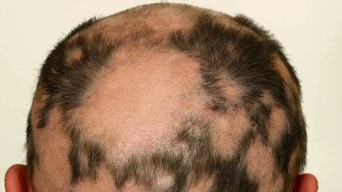 Essential Tips for Men to Prevent Excessive Hair Loss