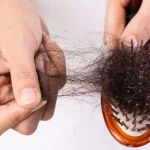 Excessive Hair Loss
