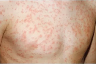 Rubella Outbreak: Gauteng and Western Cape Report Highest Cases in South Africa