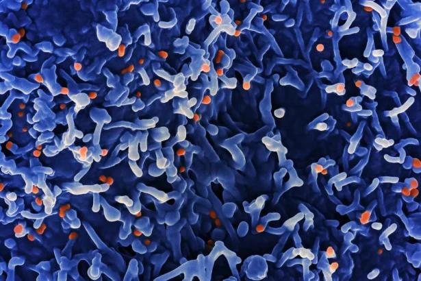 Department of health Confirms Ongoing Local Transmission of Mpox in Gauteng as Cases Rise